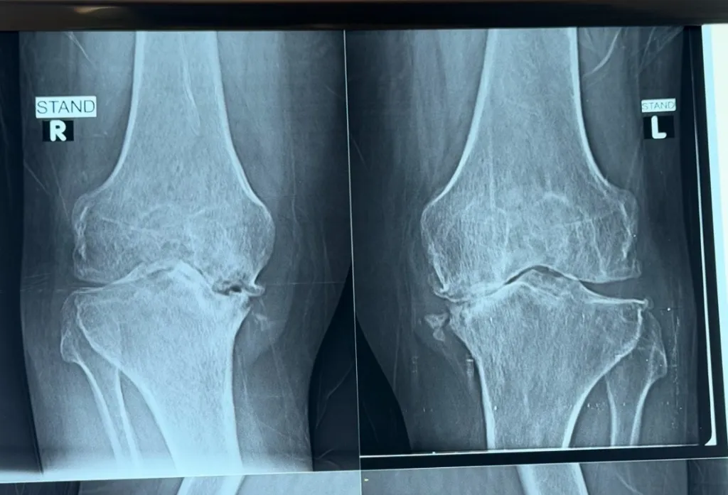 Knee Osteoarthritis Treatment Egypt | PRP & Knee Replacement Options Cairo | Dr. Labib